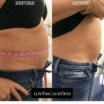 T-Shock Therapy - Before and After of woman's stomach